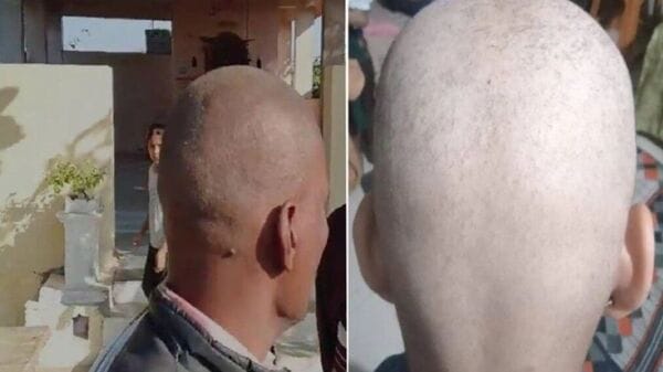 Suddenly hair loss case in india