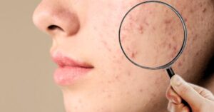 Skin Care Tips in monsoon how to treat acne at home