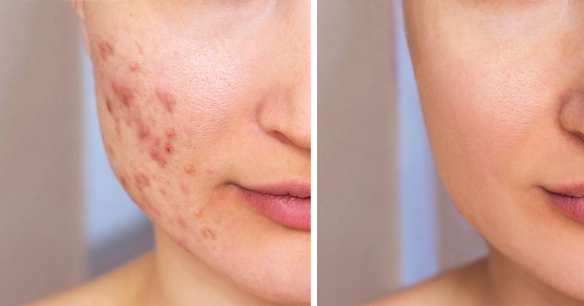 Skin Care Tips in monsoon how to treat acne at home