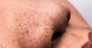 Blackheads Removal Tips on the nose and chin will be removed in just 5 minutes