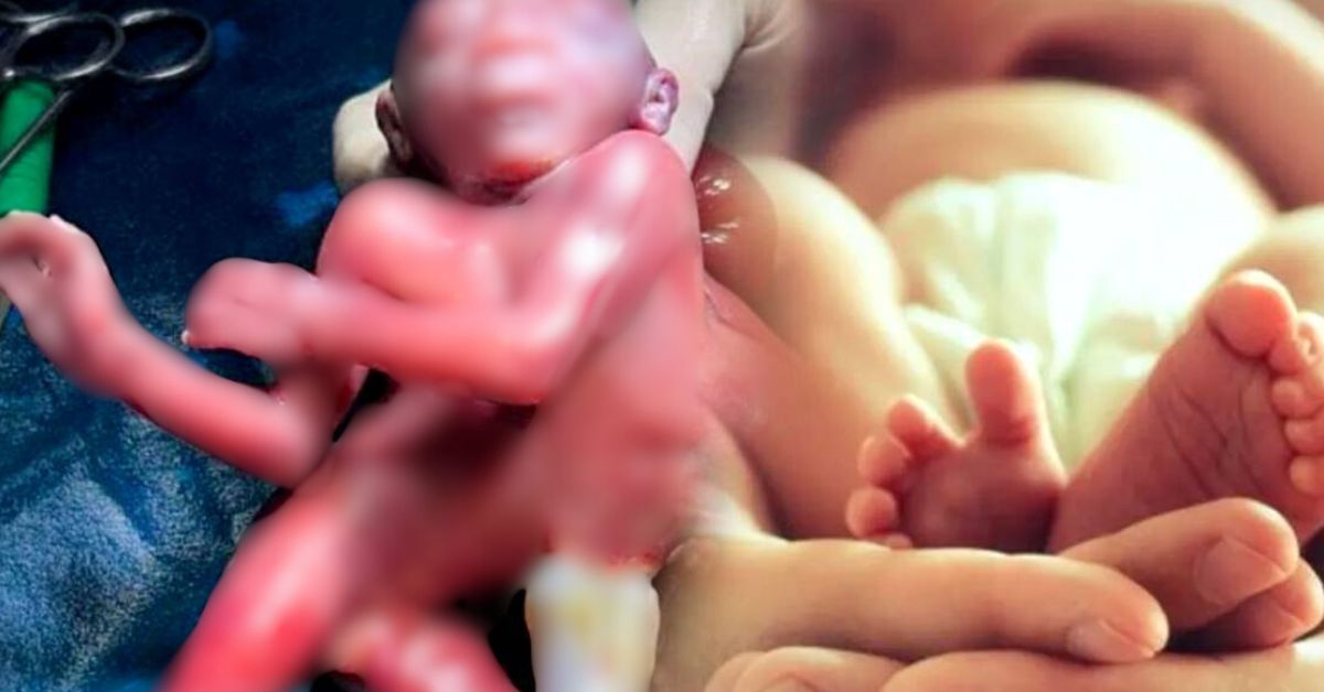 Bardhaman a strange baby born with four arms and four legs doctor shocked