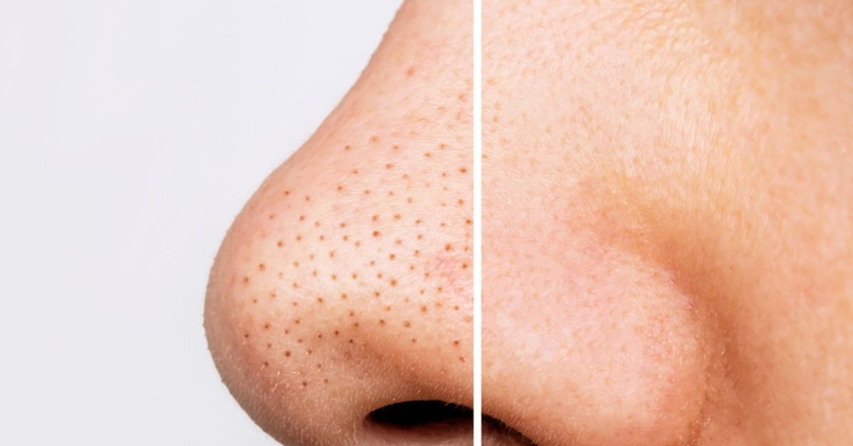 Blackheads Removal Tips on the nose and chin will be removed in just 5 minutes