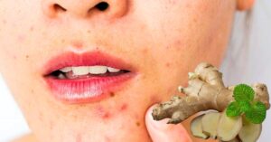 Skin Care ginger is very effective in drying out acne