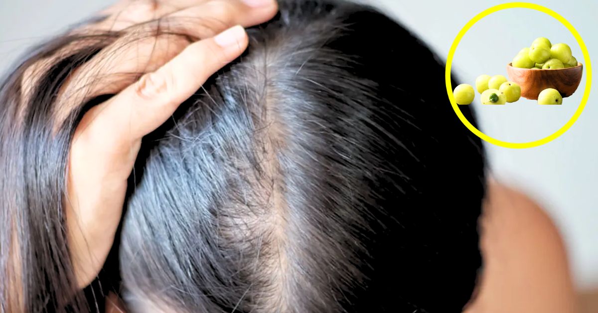 Hair Problem oily scalp is a problem during monsoon! Get rid of dandruff with this home remedy know the tips