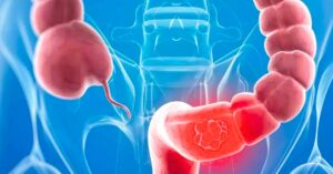 Health colon cancer is spreading rapidly due to diet and lifestyle