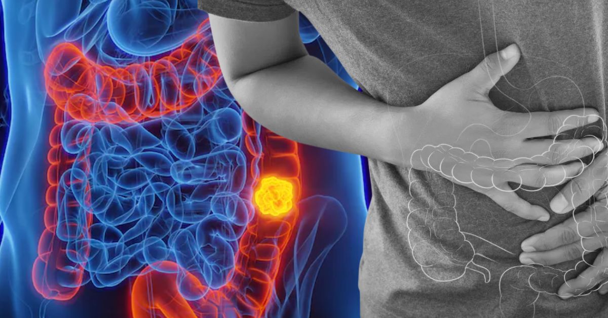 Health colon cancer is spreading rapidly due to diet and lifestyle