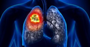 Health lung cancer can occur even if you don't smoke know the symptoms of the disease