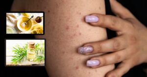 Skin Care millions of people are suffering from strawberry skin problem know the remedy