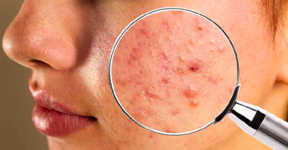 Skin Care know the special rules before Puja to avoid acne