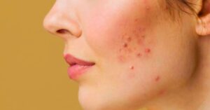 Skin Care know the special rules before Puja to avoid acne