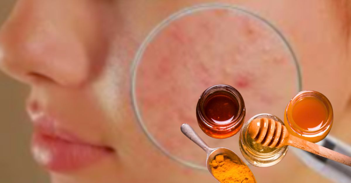 Skin Care follow these rules at home to prevent sudden acne breakouts