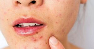 Skin Care follow these rules at home to prevent sudden acne breakouts