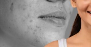 Skin Care remove blemishes and spots on your face in 5 easy tips