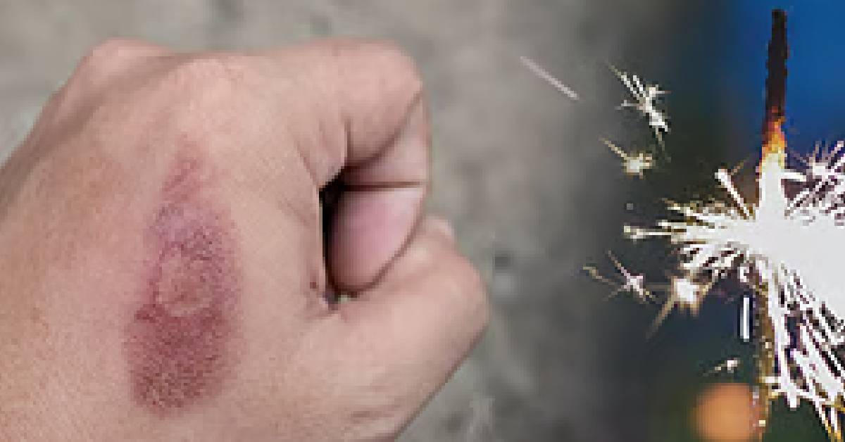 Diwali night stay safe follow these rules to prevent firecracker accidents