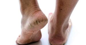 Skin Care get rid of cracked heels at home with 3 tips
