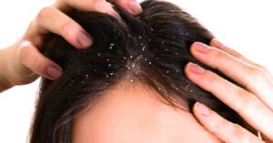 Hair Care prevent dandruff before winter use these simple tips