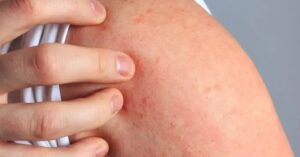 Heath eat these 5 healthy foods a day to avoid allergies