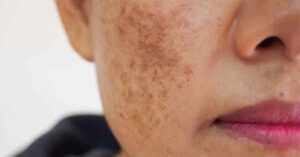 Skin Care remove blemishes and spots on your face in 5 easy tips