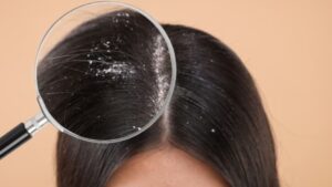 Hair Care dandruff will go away and hair will become strong with this simple rule