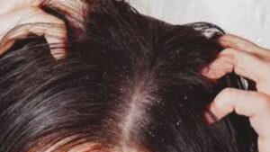 Hair Care dandruff will go away and hair will become strong with this simple rule