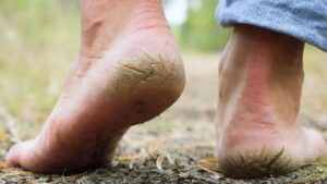 Skin Care treat cracked heels at home 5 tips to use in winter