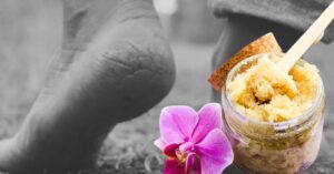 Skin Care suffering from cracked heels lemon and honey provide the solution