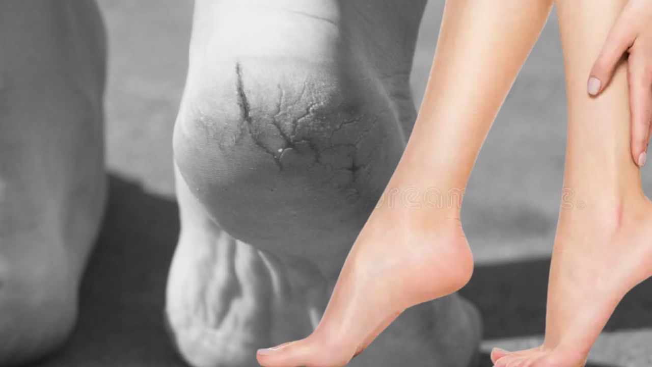 Skin Care treat cracked heels at home 5 tips to use in winter