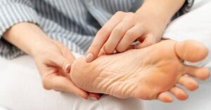 Skin Care suffering from cracked heels lemon and honey provide the solution