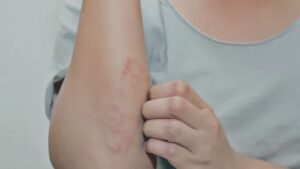 Skin Care why does dry skin itch more in winter