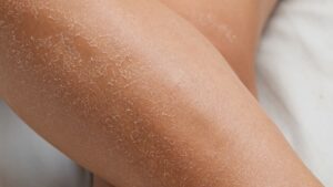 Skin Care why does skin become dry in winter know which vitamin deficiency causes this problem