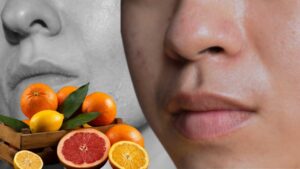 Skin Care why does skin become dry in winter know which vitamin deficiency causes this problem