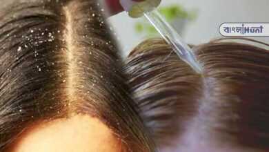 Learn how to get rid of dandruff