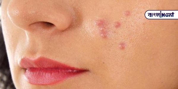 woman with hard pimples on her face